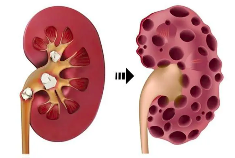 thận nhi, bệnh thận nhi, nhiễm trùng tiểu ở trẻ, viêm cầu thận trẻ em, lupus thận, ghép thận trẻ em